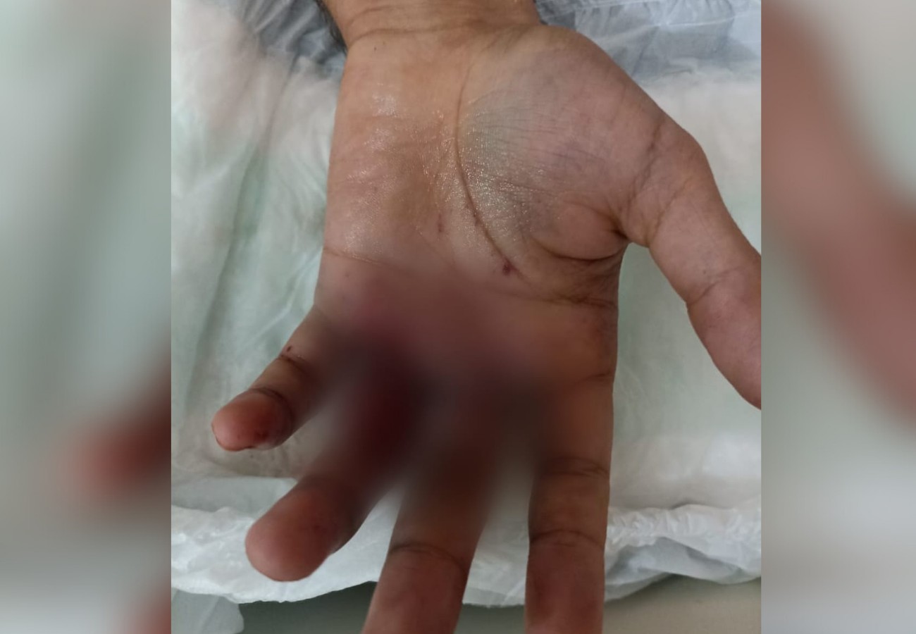 Jovem fica ferido após bolo explodir em suas mãos durante aniversário: ‘Falaram que tinha uma surpresa dentro’, diz mãe